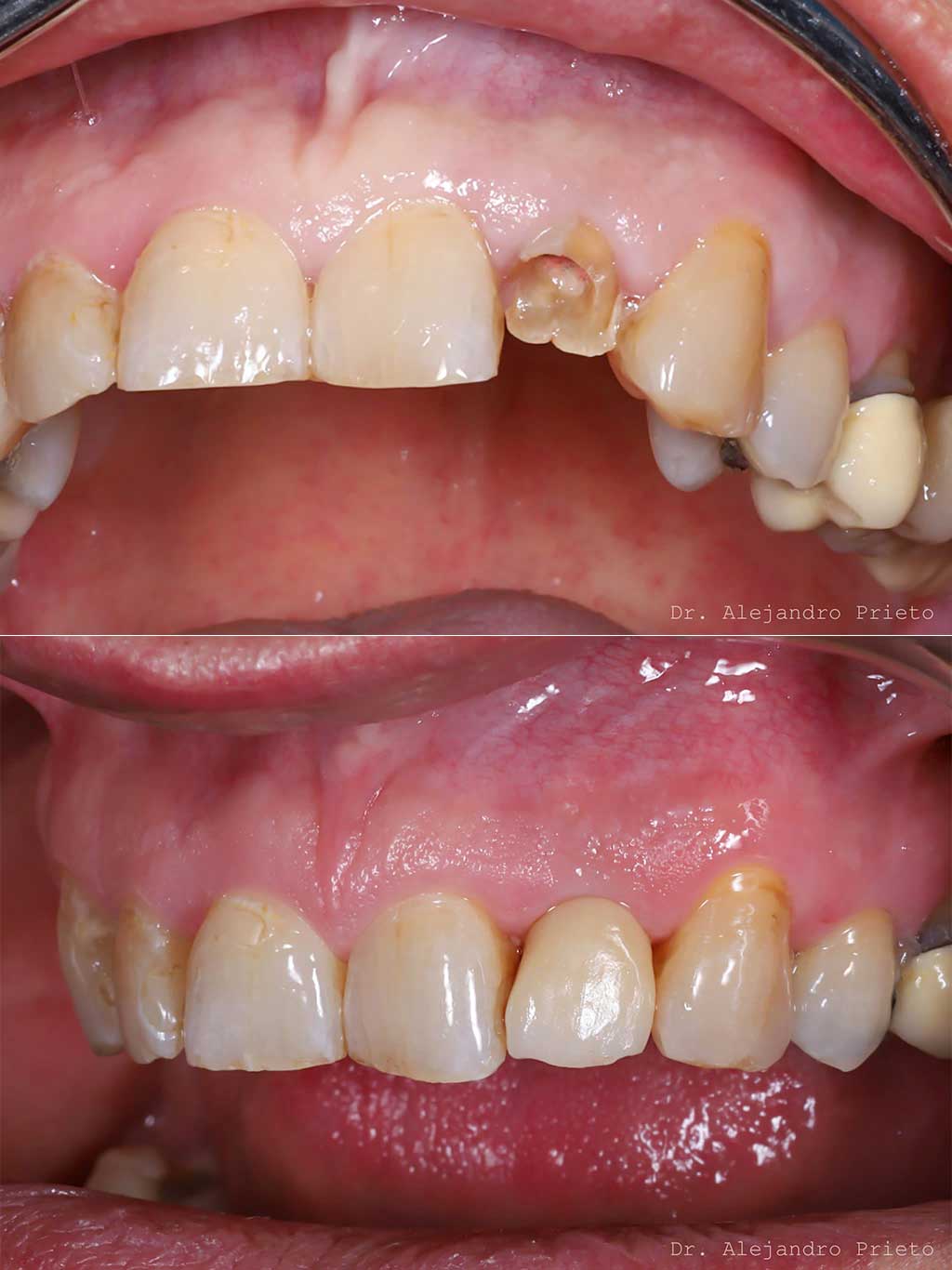 blanqueamiento dental Madrid
