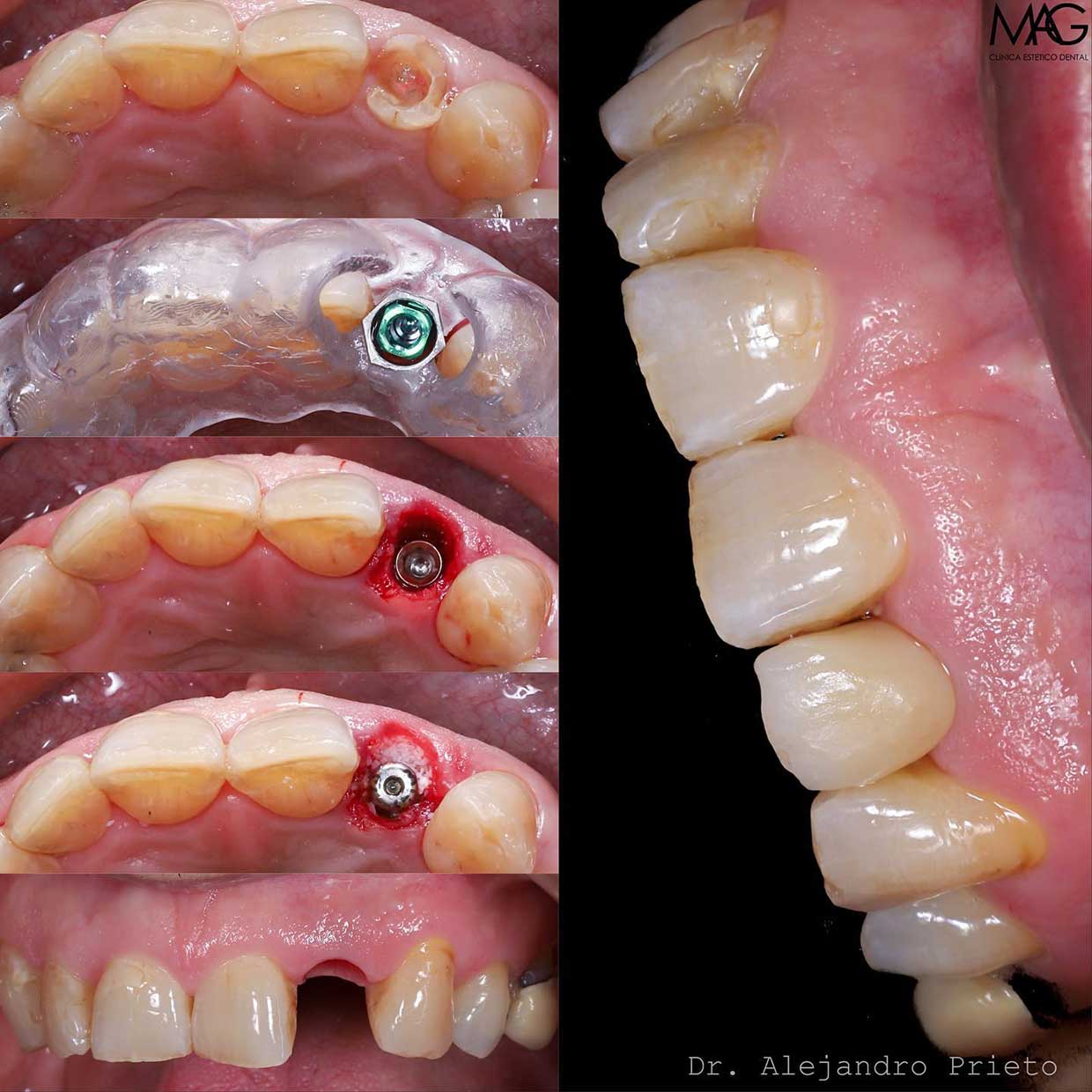 blanqueamiento dental Madrid