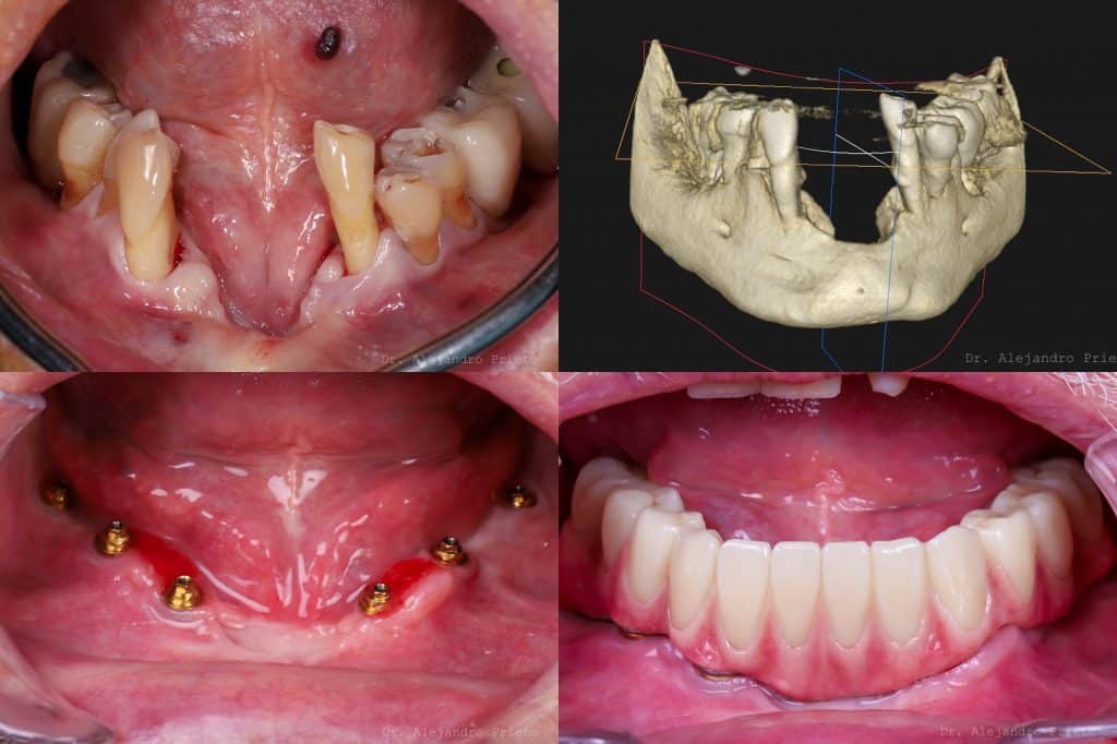 implantes dentales sin hueso maxilar inferior