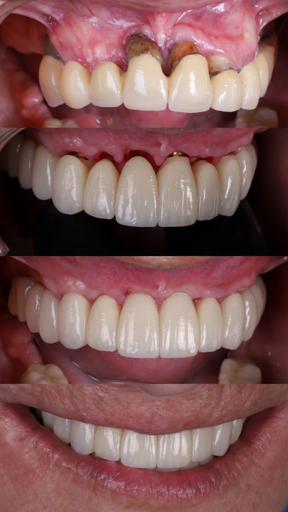 implantes sin hueso precios