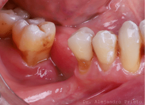 Caso de paciente con falta de hueso antes de regeneración ósea para implantes dentales