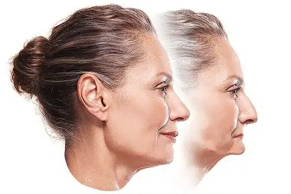 reabsorción hueso maxilar