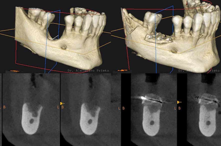 Radiografía de antes y después en paciente con poco hueso