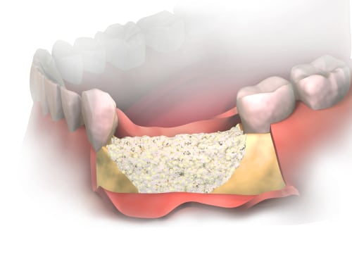 cómo poner implantes sin hueso dental