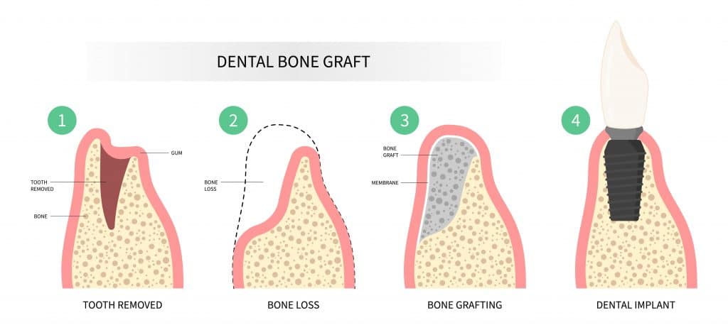 implantes dentales sin hueso