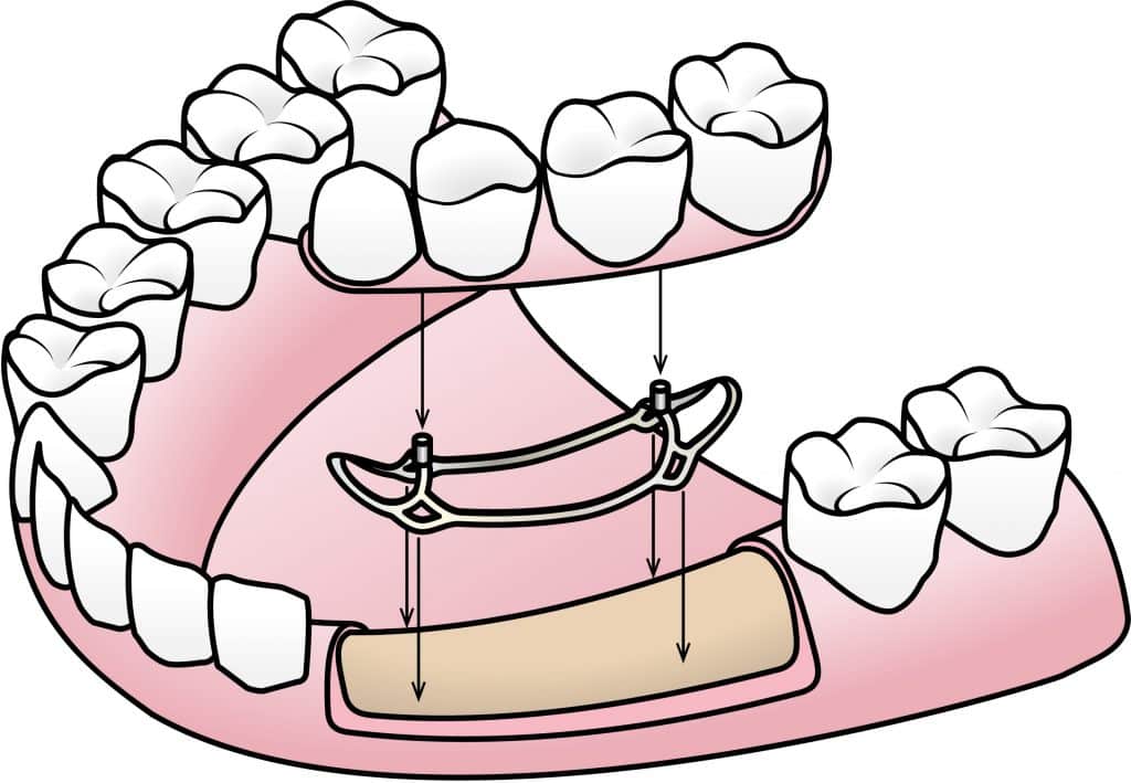 implantes sin tornillos