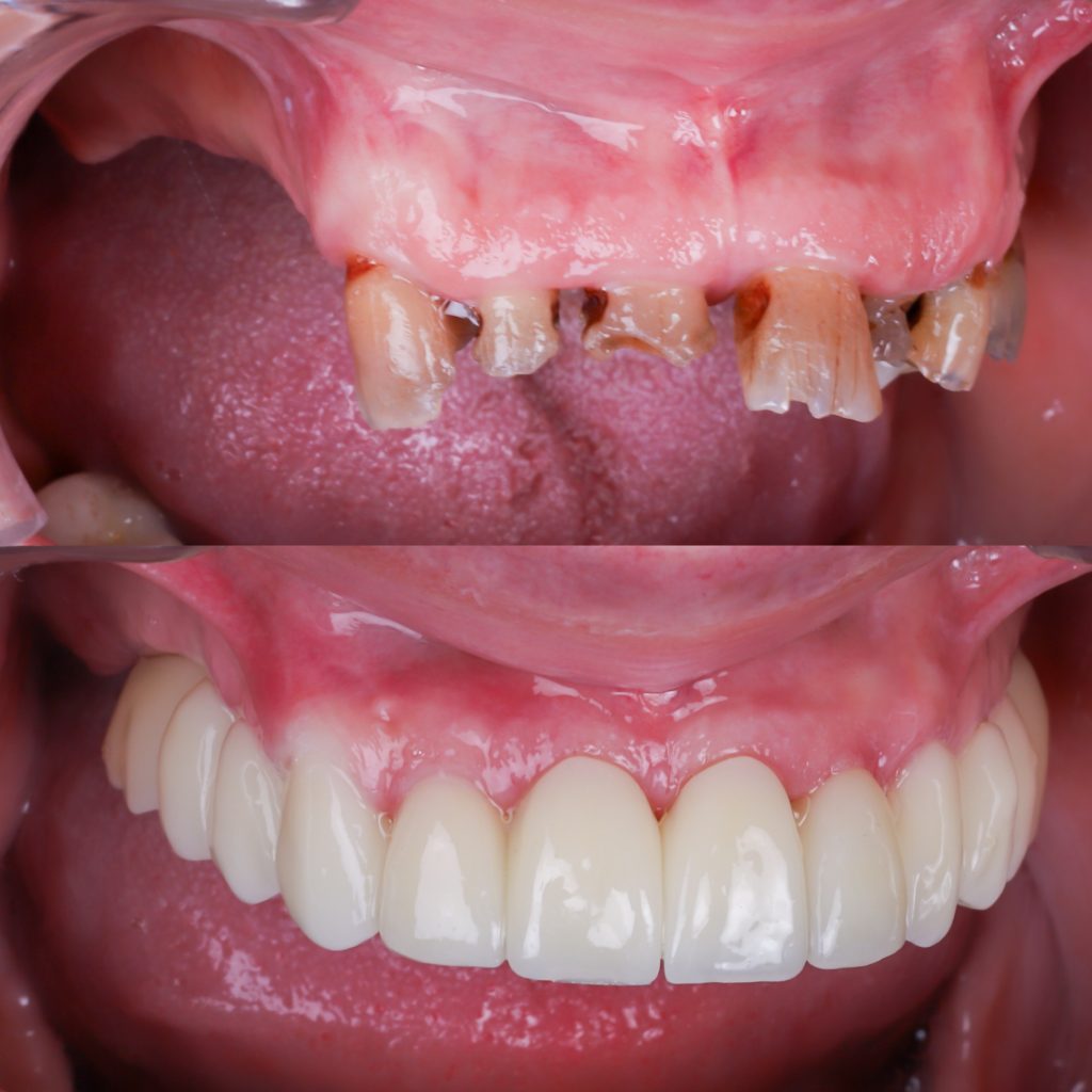 foto antes y después de implantes dentales para toda la boca
