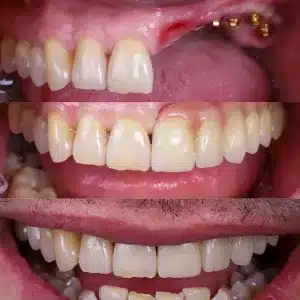 foto de antes y después de regeneración ósea para implantes dentales