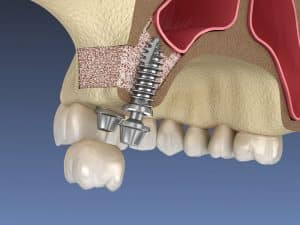 foto de elevación seno maxilar injerto hueso para implantes dentales
