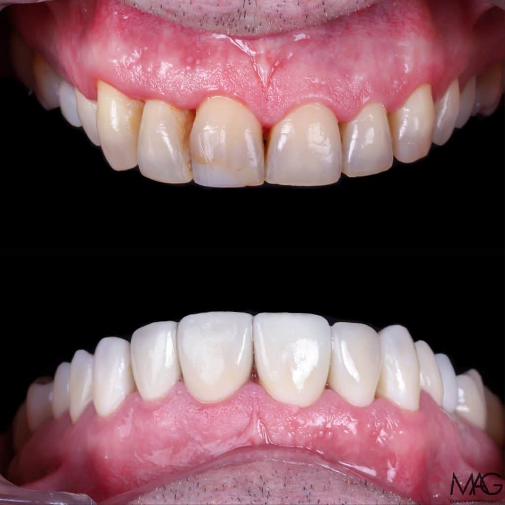 antes y después diseño digital de sonrisa para carillas dentales
